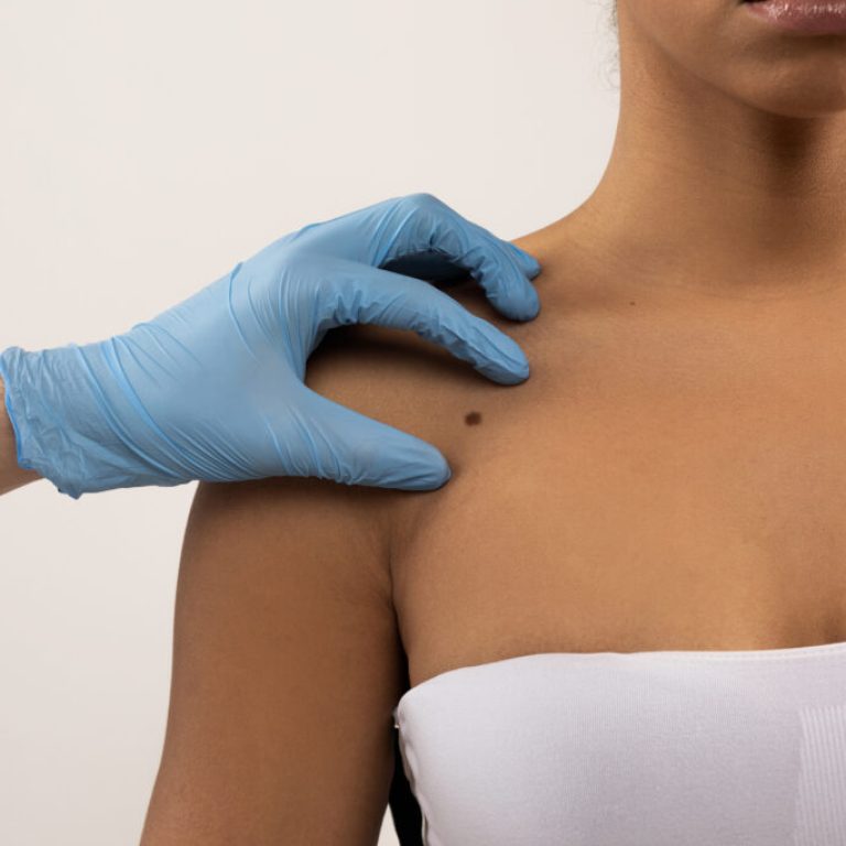 Oncologist wearing blue medical gloves examining patient half-naked black woman skin in clinic, touching mole nevus, isolated on grey background. Cancer awareness, oncology concept