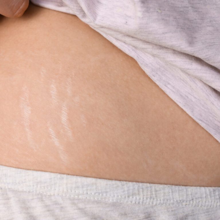Female body with stretch marks close-up. Problematic skin of a girl with changes after childbirth, and weight gain.